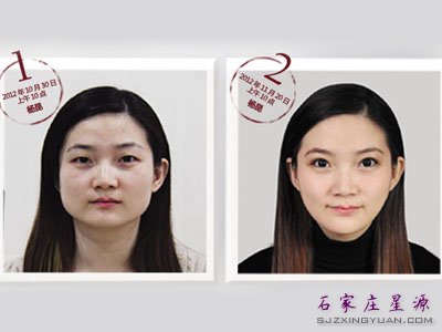 杨昆整形前后对比照片