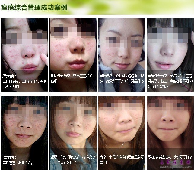 星源医疗美容医院真实祛痘案例