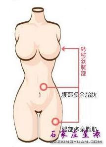 自体脂肪丰胸 吸脂塑造又丰胸一举两得