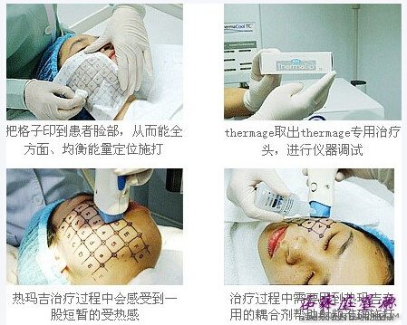 不老法宝——热玛吉