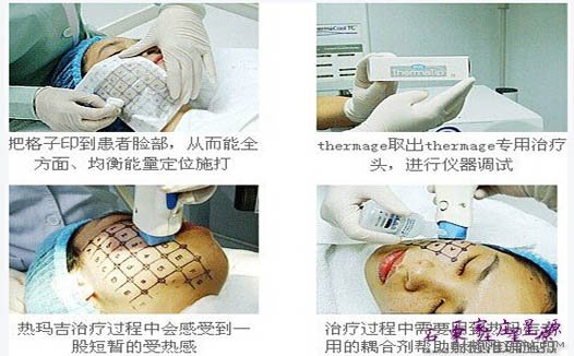 女性抗衰的医美奢侈品——热玛吉