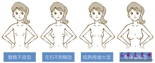 自体脂肪‘——丰胸