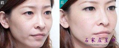 眼袋手术真人对比案例