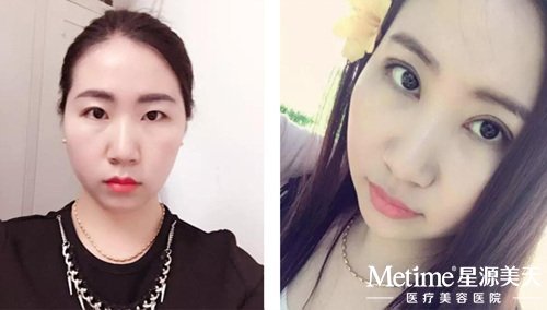 星源美天贝塞尔真实案例