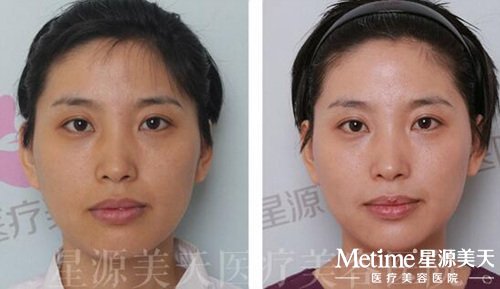 星源美天水光注射真人案例分享