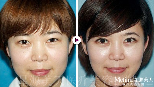 ˫��Ƥ��ʵ����