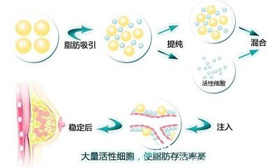 石家庄自体脂肪填充丰胸的安全性如何