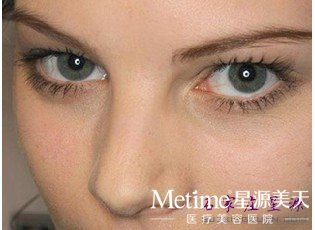 自体软骨隆鼻 打造精致面容