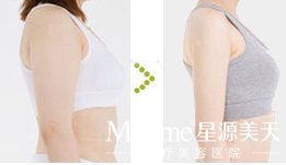 乳房松弛怎么办