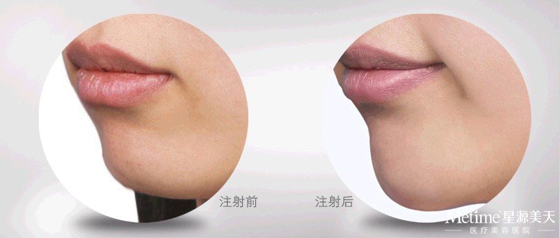 注射玻尿酸丰下巴自然吗
