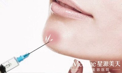 用玻尿酸丰下巴效果好吗