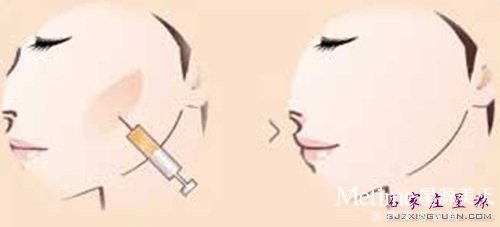 注射丰苹果肌 图示