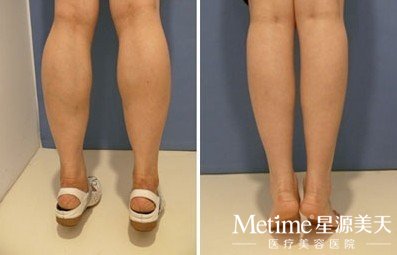 注射botox瘦小腿效果如何