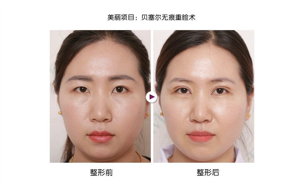 星源美天做切开双眼皮效果如何