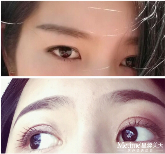 内双如何自然的变双眼皮