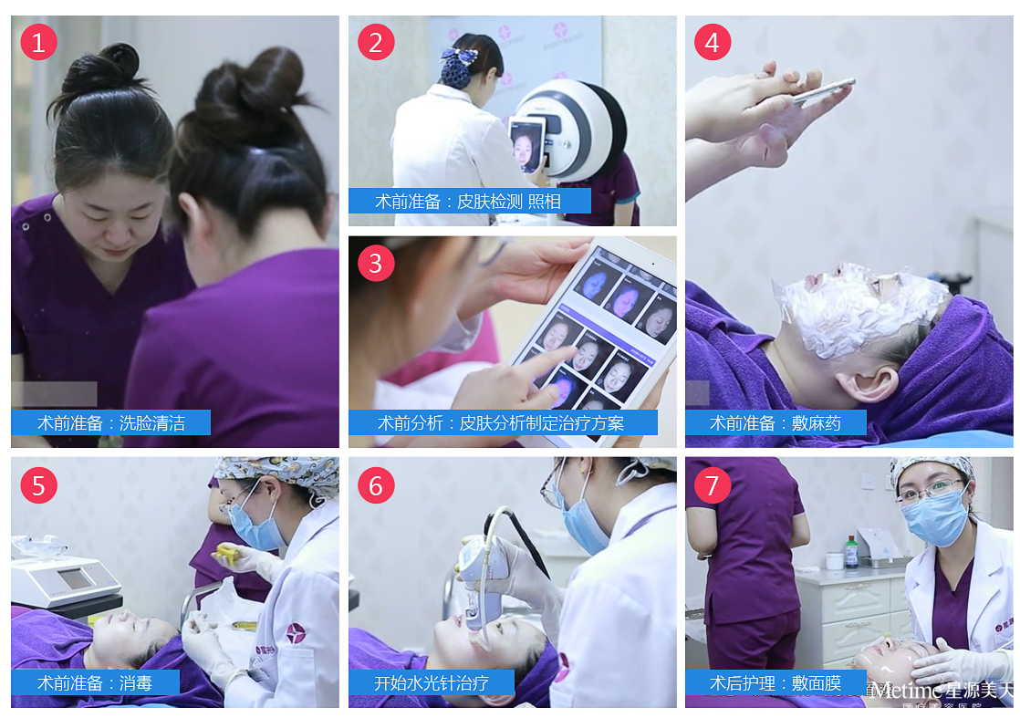 水光针真实注射过程