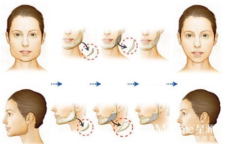 打瘦脸针一周后效果图