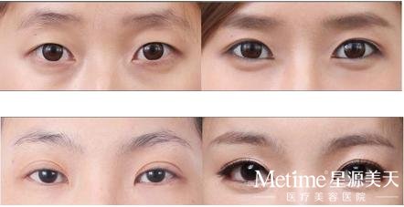 切开双眼皮和埋线双眼皮对比