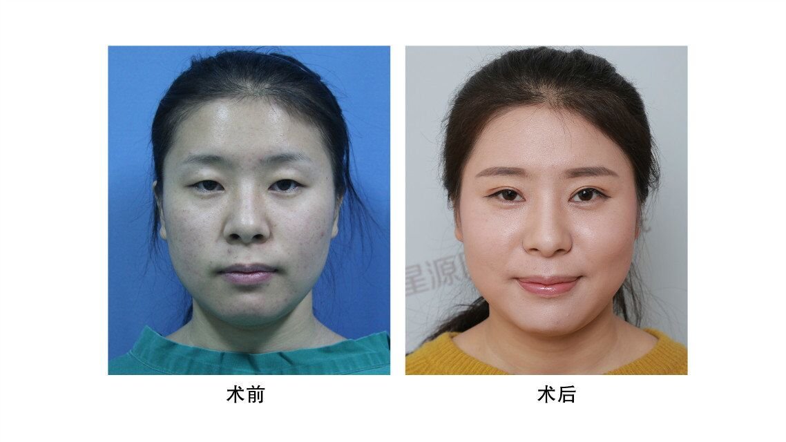 肌肤暗黄毛孔粗大怎么办?