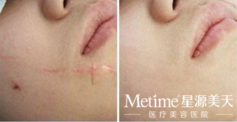脸上有疤痕如何治疗