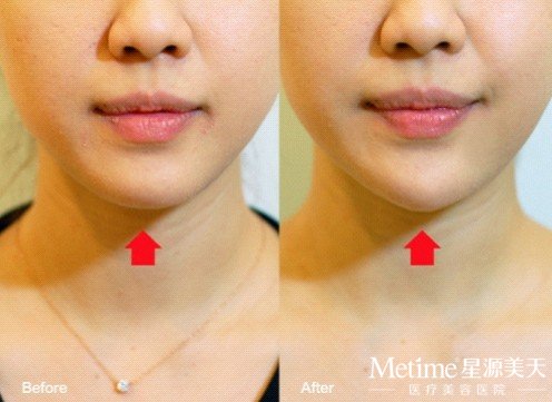 注射玻尿酸丰下巴