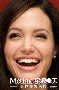 埋线双眼皮价格不是固定的