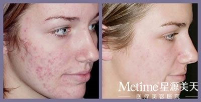 激光去痘印效果