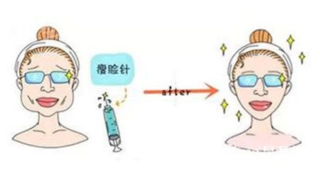 注射保妥适瘦脸针大约多少钱