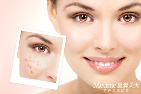 激光祛痘怎么样