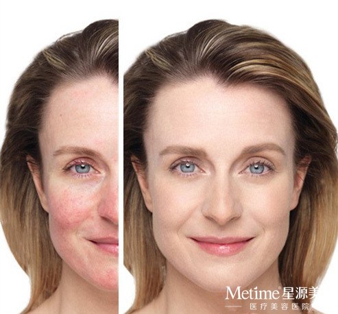 脸上的红血丝能祛除吗