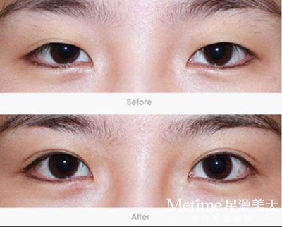 ��˫��Ƥ�ָ�ʱ��ܶ�