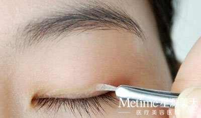 经常贴眼皮贴还能做双眼皮吗