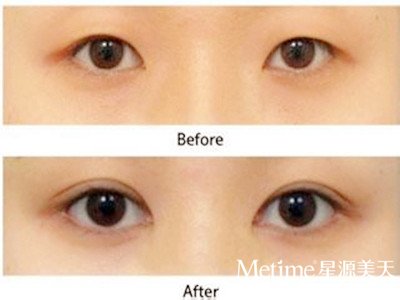 做切开双眼皮术后会留下疤痕吗