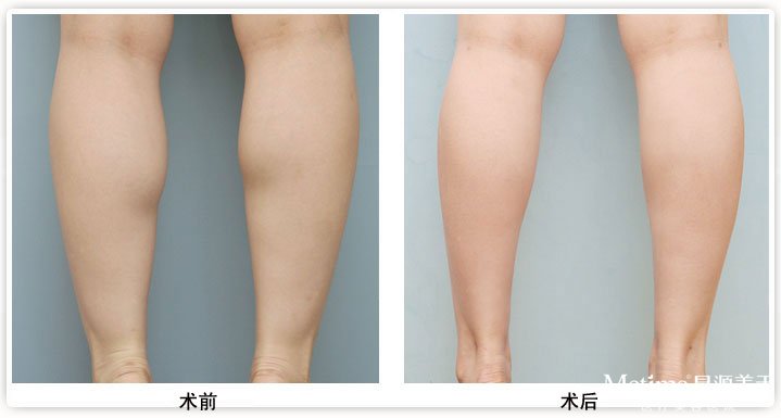 打瘦腿针会有什么后遗症