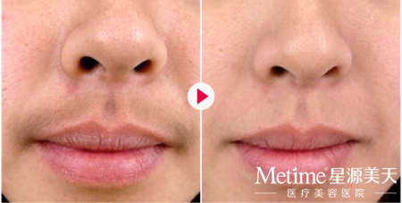 激光脱唇毛效果好吗