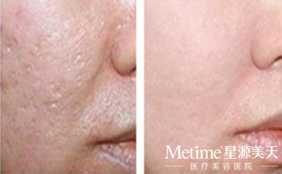 如何轻松祛除痘坑呢