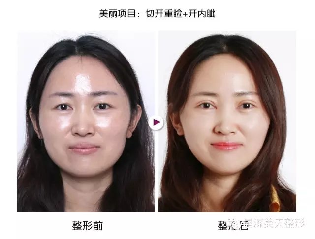 ����˫��Ƥ�೤ʱ���ܻ�ױ