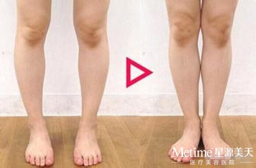 O型腿怎么办