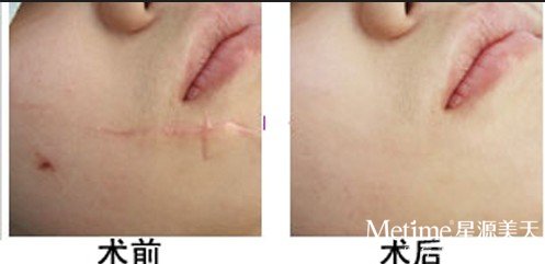 你的疤痕应该用什么方法祛除