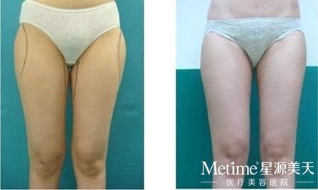 大腿吸脂效果明显吗