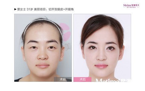 割双眼皮看上去自然吗