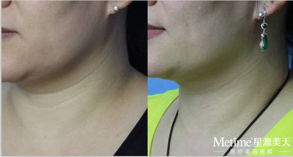 嗨体祛除颈纹好不好