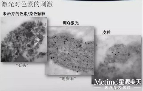 Ƥ�뼤��Ժ�ɫ�صĴ̼�