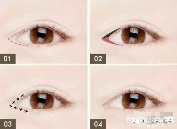 开眼角是越尖越好吗