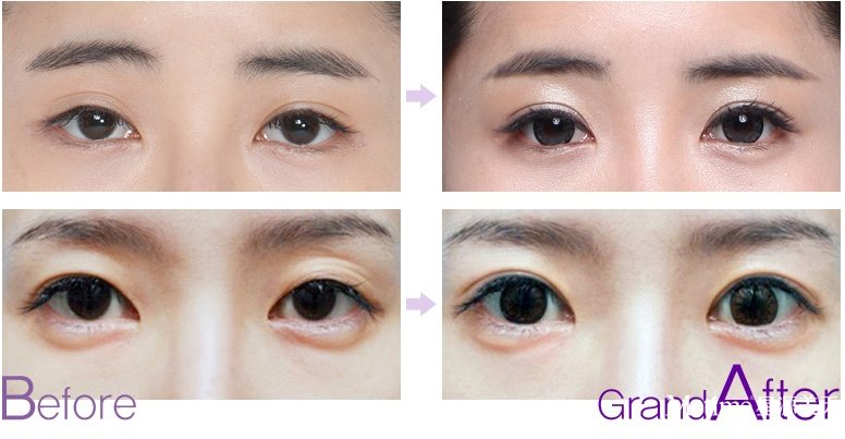 双眼皮修复的&佳时间