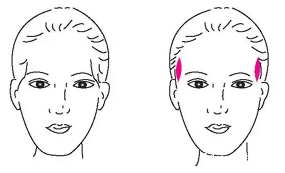 玻尿酸丰太阳穴