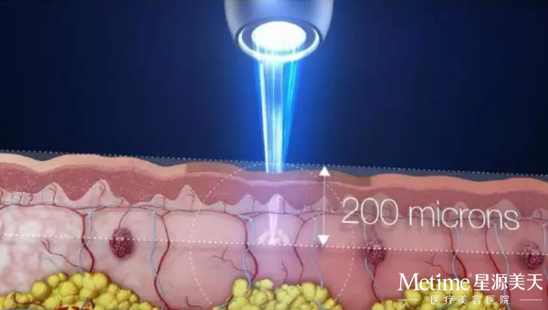 Ƥ�뼤�������ɶ��������