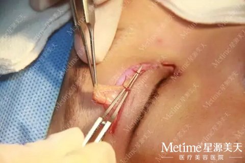 精细分离 完整保留皮下血管网