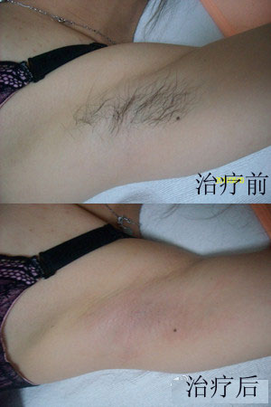 激光快速帮女士祛除毛发