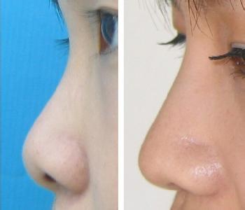 李小姐:自体组织隆鼻真人案例